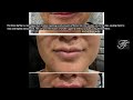 Botox lip flip in chandler az  flawlessfacesazcom