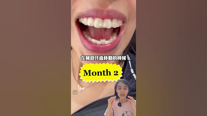 她的牙齿上长青春痘!?#隐形牙套#隐适美 - 天天要闻