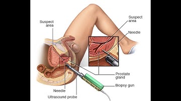 Cystourethroscopy with Meatotomy CPT code - simplify medical coding