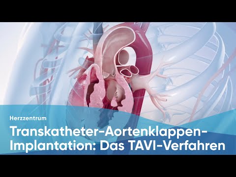 Video: Klinische Ergebnisse Nach Transkatheter-Aortenklappenersatz Bei Mit Ionisierender Strahlung Behandelten Krebsüberlebenden