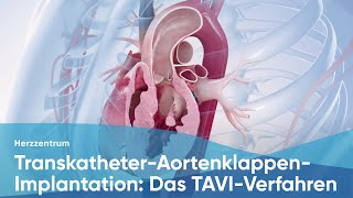 Transkatheter-Aortenklappen-Implantation: Das TAVI-Verfahren