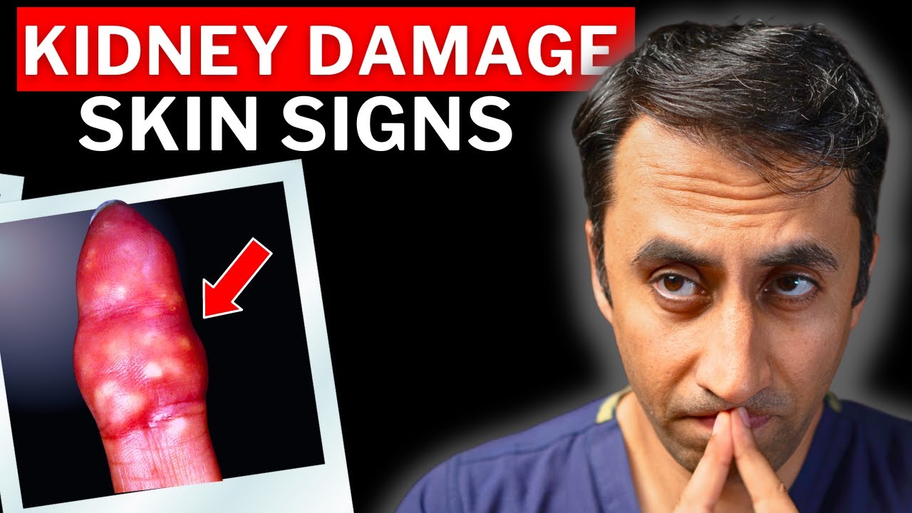 Doctor Explains 7 Skin Signs Of Chronic Kidney Disease CKD Never Doctor Explains 7 Skin Signs Of Chronic Kidney Disease CKD Never