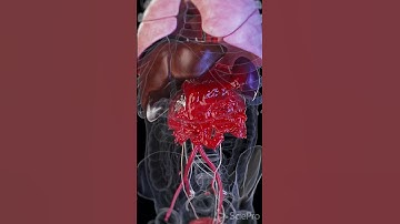 Abdominal Aortic Aneurysm Rupture