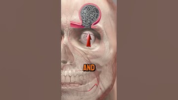 🧠 Brain Aneurysm & Coiling: No scalpel surgery