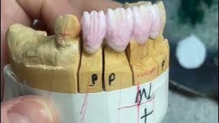 How to Build up a Porcelain Bridge #7#8#9#10