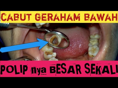 Proses Pencabutan Gigi Geraham Bungsu (Geraham Ujung) | Dokter Gigi Tri Putra. 