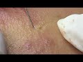Acne treatment for spa linh mun 2024 80
