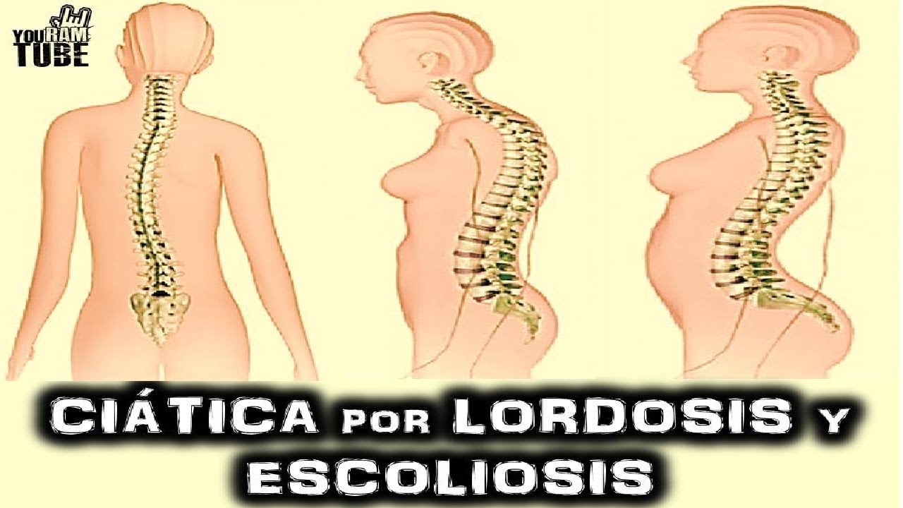 Tendinitis del cuádriceps código icd 10 para hipertensión