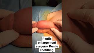Penile enlargement surgery - Penile lipofilling Dr Araz Bayramov #andrologist #penissurgery