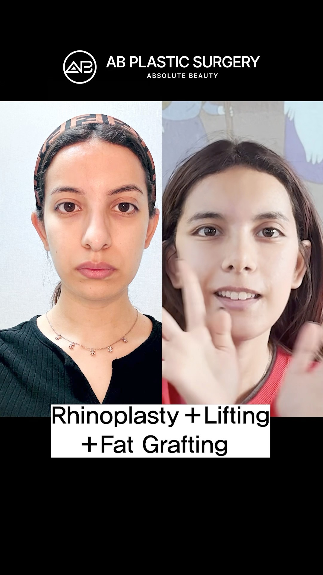 Rhinoplasty and Facelift Results in 30 Seconds #koreanplasticsurgery