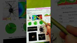 Monitoring Glaucoma Progression With Oct Report