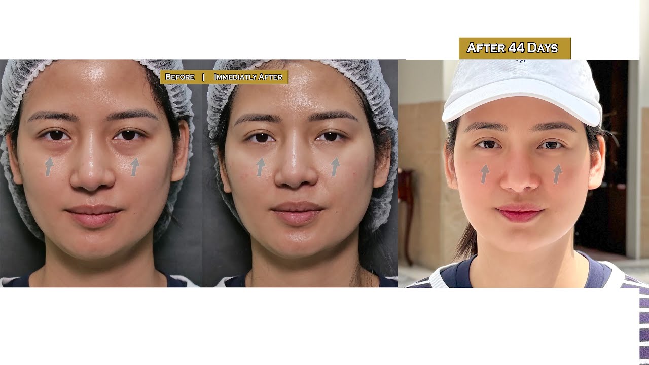 Look beautiful with the Bright Eyes treatment | Dr. Contessa Salvador