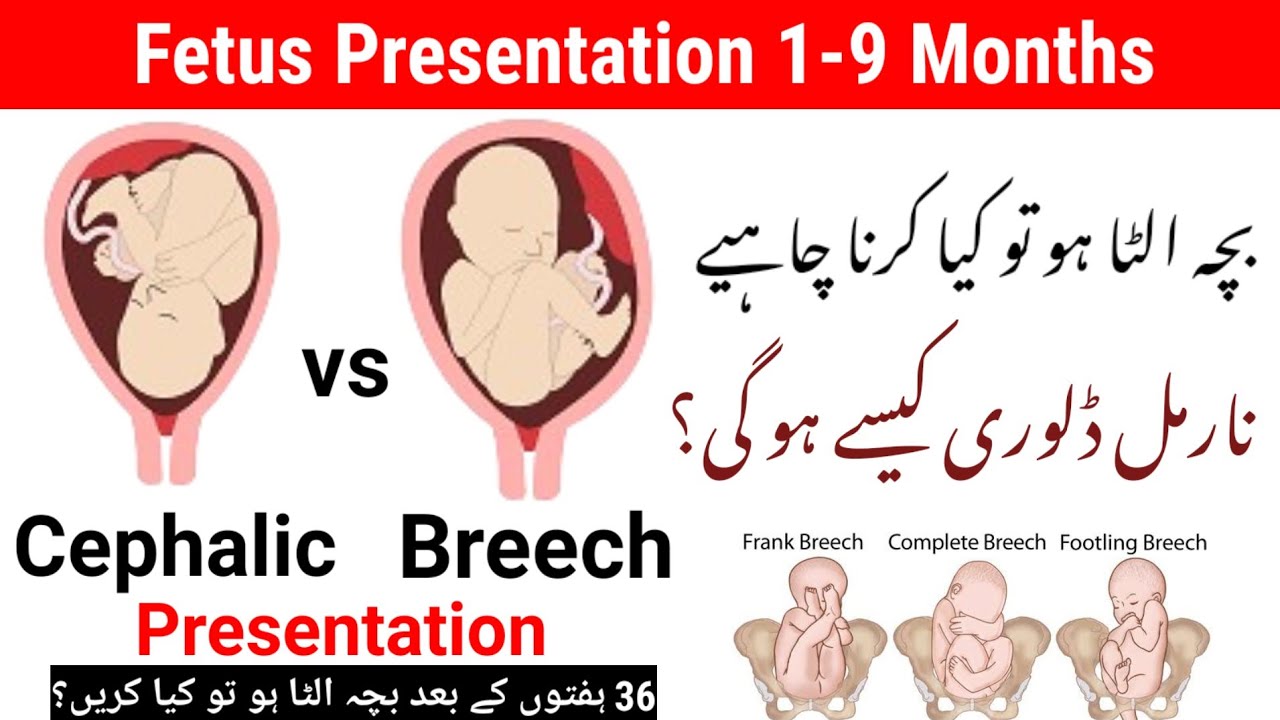 breech presentation in urdu
