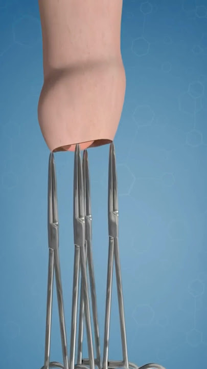 “Circumcision: Ancient Ritual to Modern Choice”       Video credit:Grace Lu (Youtube.com)