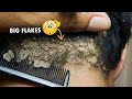 Scratching Dandruff Off Scalp Psoriasis On Back Side #393