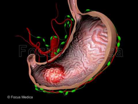 Gastric MALT Lymphoma