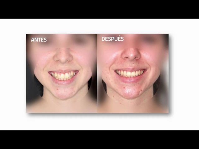 que pasa despues de quitarse los brackets que pasa despues de quitarse los brackets
