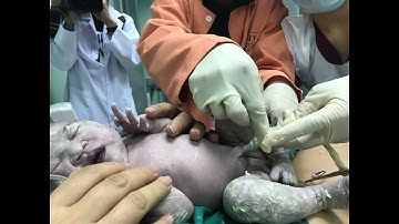 HAPPY / Cận cảnh ông bố tự tay cắt dây rốn cho con trong phòng sinh