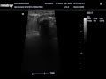 Ultrasound diagnosis of intestine foreign body