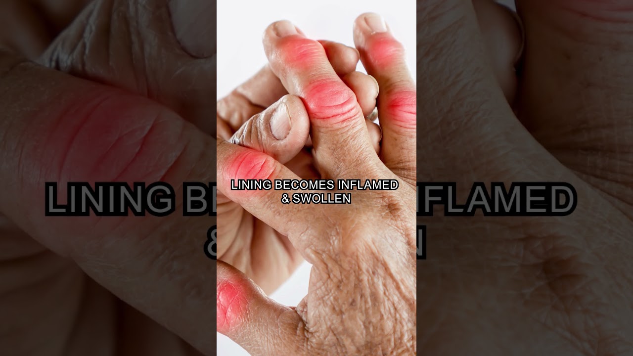 There is no cure for rheumatoid arthritis.