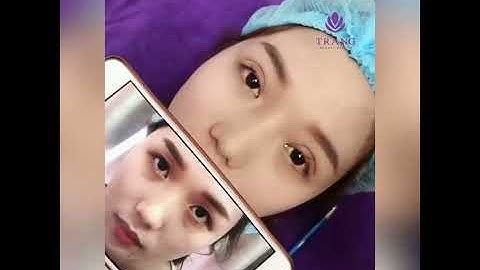 Video cắt mí mini-deep số 2