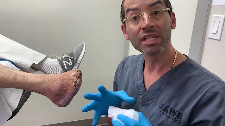 CASE UPDATE: TRANSMETATARSAL AMPUTATION 👣👣👣👣