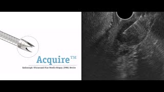 EUS-FNB of a gastric GIST with Boston Acquire 22G