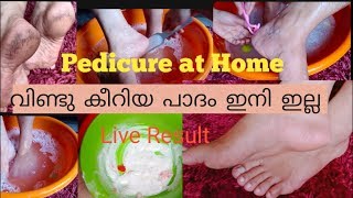 PEDICURE at Home. പാദം വിണ്ടു കീറുന്നതിനു ഒരു Super Remedy..