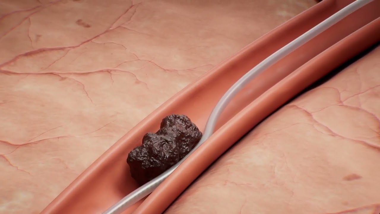 Vesalio pVasc™ Thrombectomy System Procedure Animation