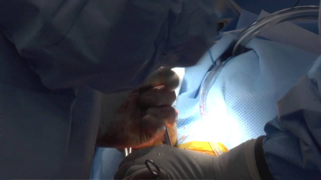 Mini Open Rotator Cuff Repair Dr. John C. Kagan M.D. Fort Myers