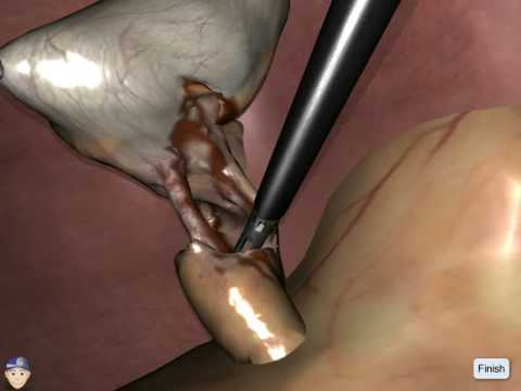 LapSim Cholecystectomy: Dissection