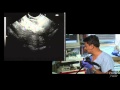 Pancreatic Cyst - Dr. Anand Sahai MD