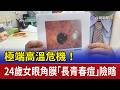 極端高溫危機！ 24歲女眼角膜「長青春痘」險瞎