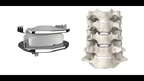 C6-C7 Disc replacement