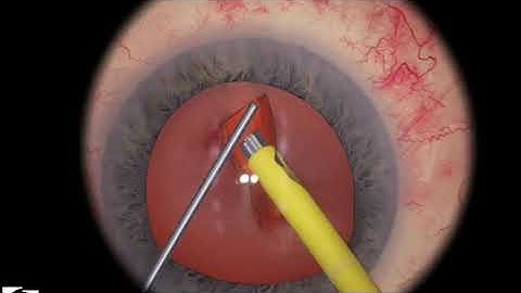 EyeSi CAT C Phaco Divide and Conquer, Level 5