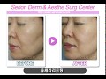 *황규광원장의 피부성형* 울쎄라 얼굴 리프팅 치료 Ulthera Nonsurgical Facial Lifting, Korean Best, Serion Dermatology