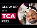 Glow Up with TCA Peel: Transform Your Skin and Boost Confidence!