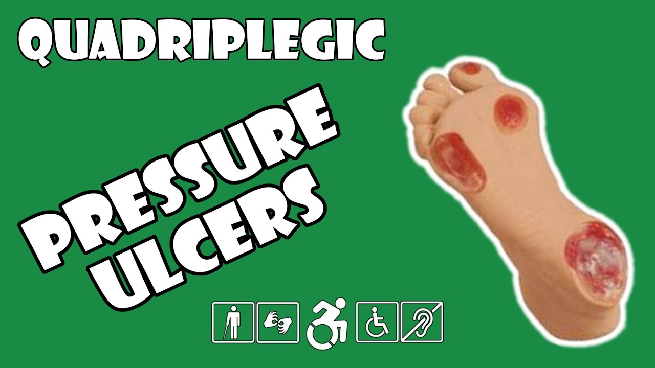 Buy Ulcer Solutions Ankle Keeper for Pressure Sores at Medical Monks!