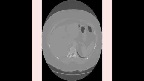 Lung Cancer Detection using Artificial intelligence