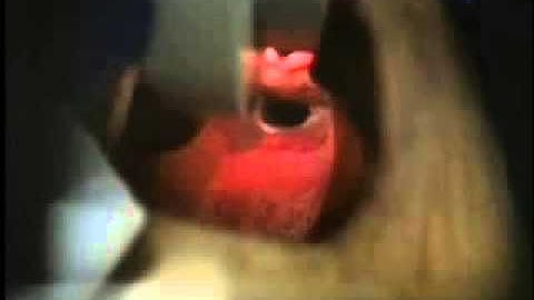 Laryngoscopic review of Trachea and Esophagus Completed w narration