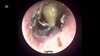 ASMR 고막에 붙은 딱딱한 귀지 제거 (Hard Earwax Removal)