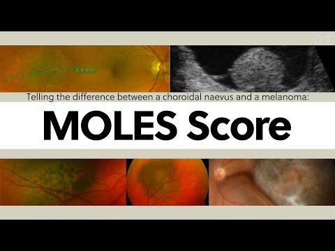 Telling the difference between a choroidal naevus and a melanoma: The MOLES Score | OT Skills Guide