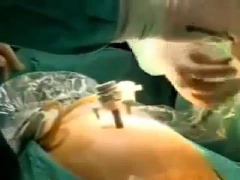 Laparoskopik Histerektomi Dr Resad Paya Pasic