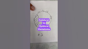 Subdural versus epidural hematoma #MedSchool #MedicalEducation #Neurosurgery