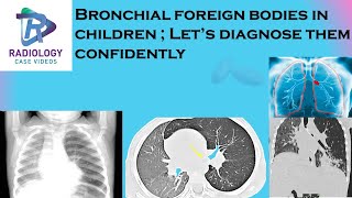 Bronchial foreign bodies in children# Unilateral hyperlucent lung#Lung Collapse