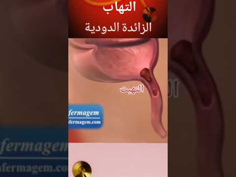 التهاب الزائدة الدوديه 