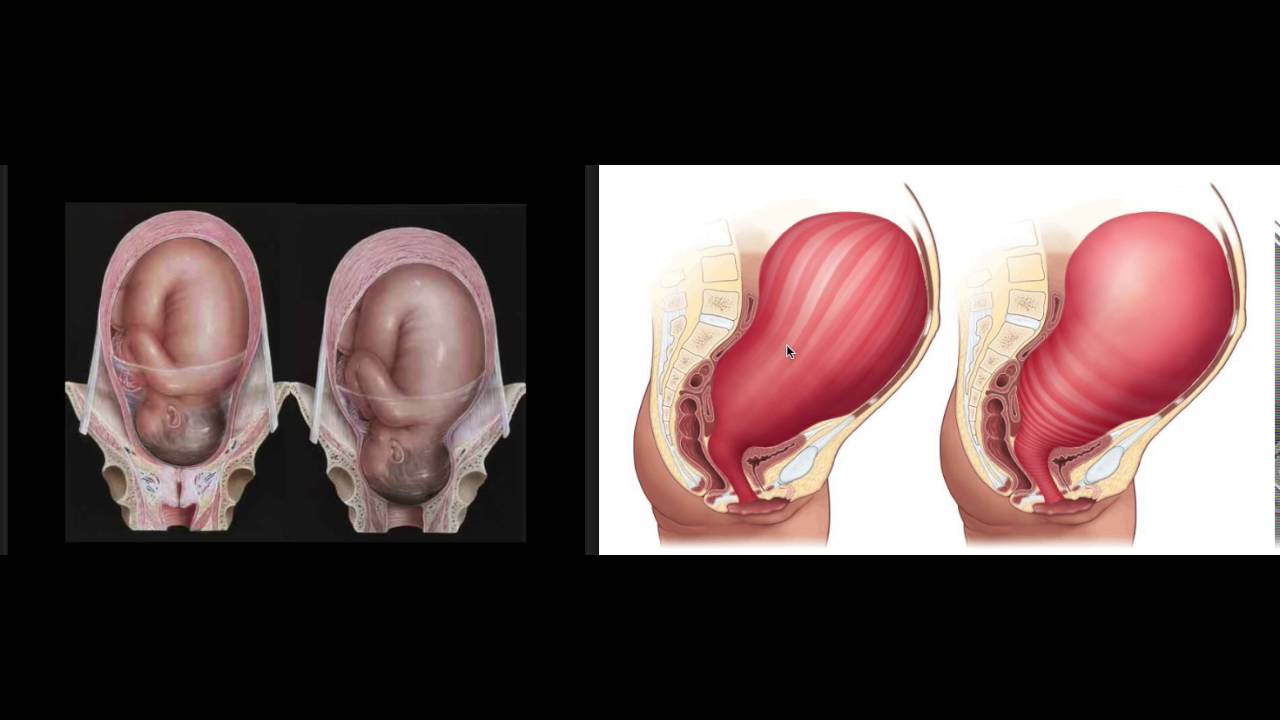 Do You Know About The Muscles Of The Uterus And What They Are Doing During A Contraction The Uterus Is Incredible Understan In 2021 Uterus Mini Lessons Hypnobirthing