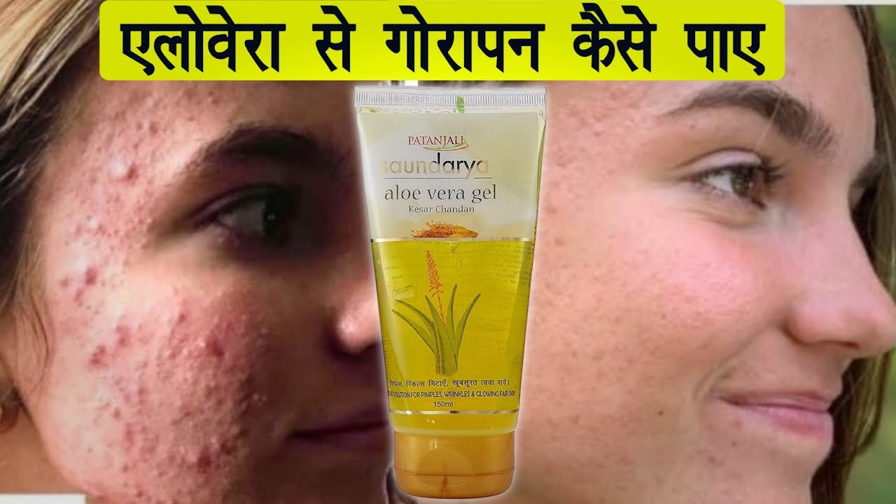 Patanjali aloevera gel kesar chadan Miracle benefit in skin 💫