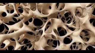 ماهي أعراض هشاشة العظام؟symptoms and signs of osteoporosis