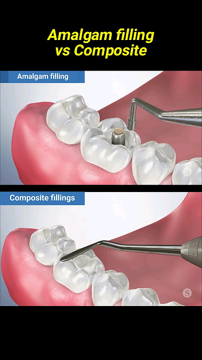 Amalgam filling vs composite #dentist #dentisty #filling
